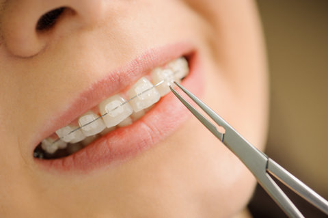 A lady with ceramic braces