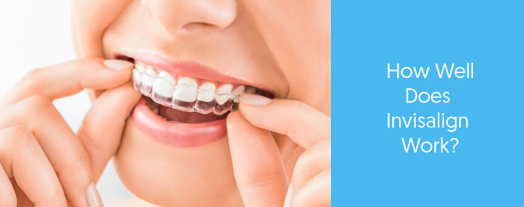 crooked Teeth and Invisalign - Dental Aware feature image