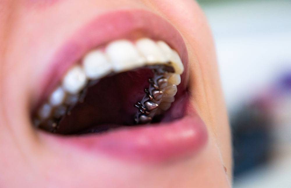 A woman with lingual braces