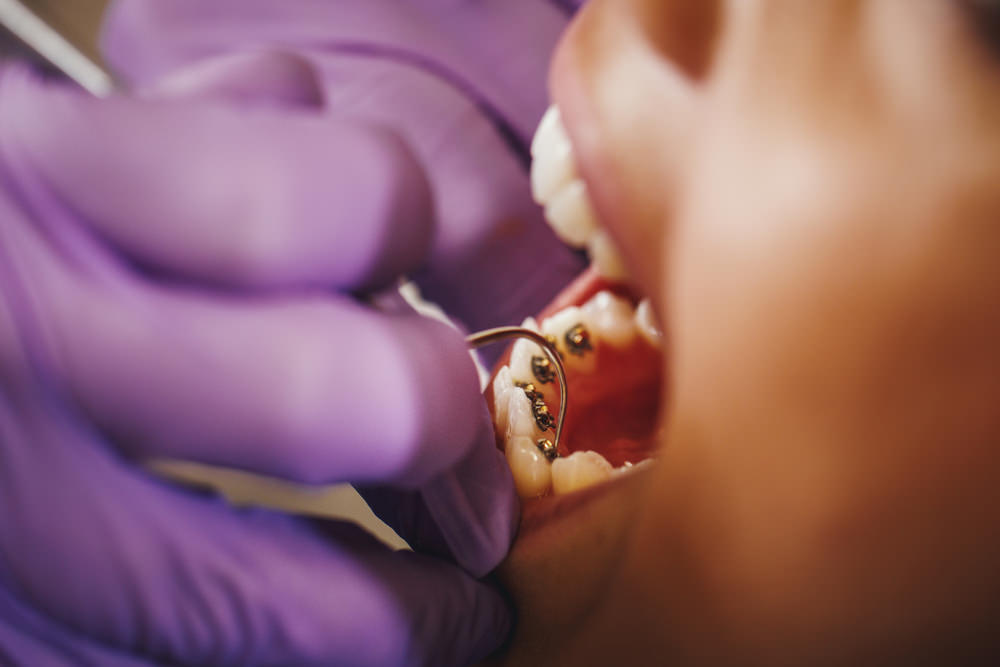 A dentist checking a patients lingual braces