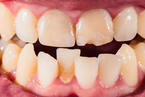 Dental work needed prior to getting Invisalign