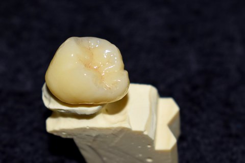 A dental Crown ready to be fitted
