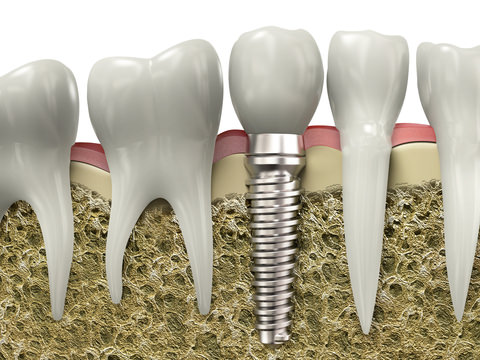 A dental Implant Illustration