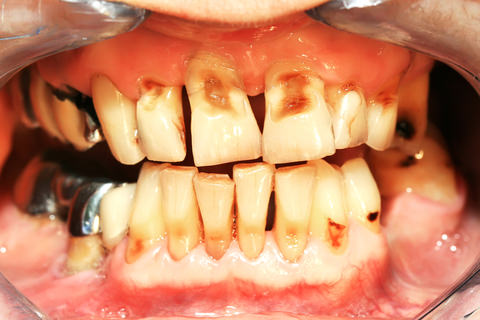 Periodontitis