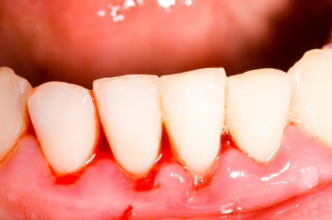 Gingivitis - Bleeding gums and plague build up