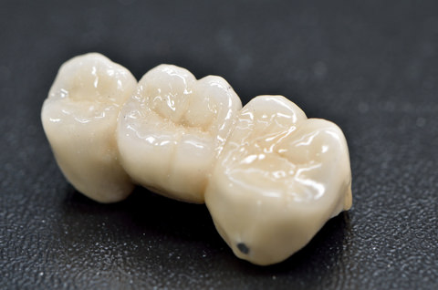 A dental bridge for a missing tooth