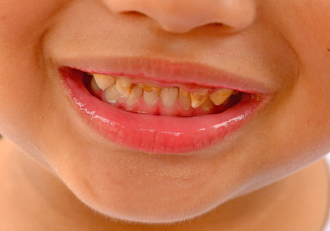 A child with dental caries
