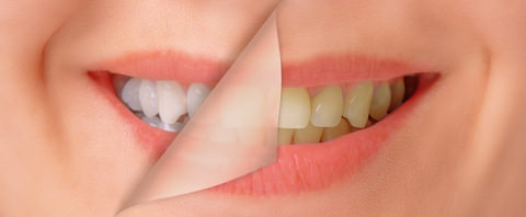 Teeth whitening before cosmetic treatments?