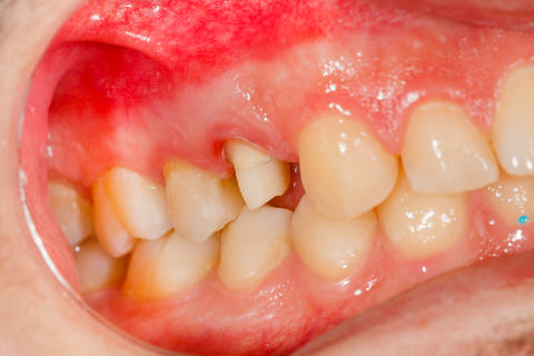 Dental crown tooth preparation