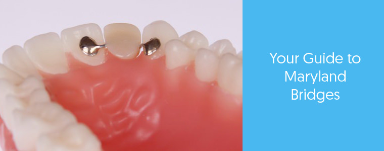 What is a Maryland bridge? Dental Aware feature image