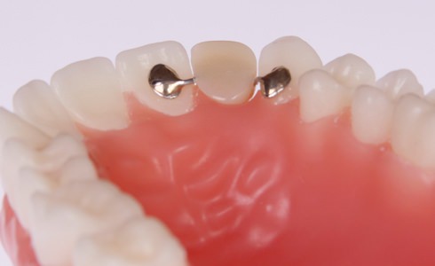 What is a Maryland Bridge and do I Need one? | Dental ... What is a Maryland Bridge and do I Need one? | Dental ...