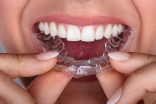 Invisalign mouth tray