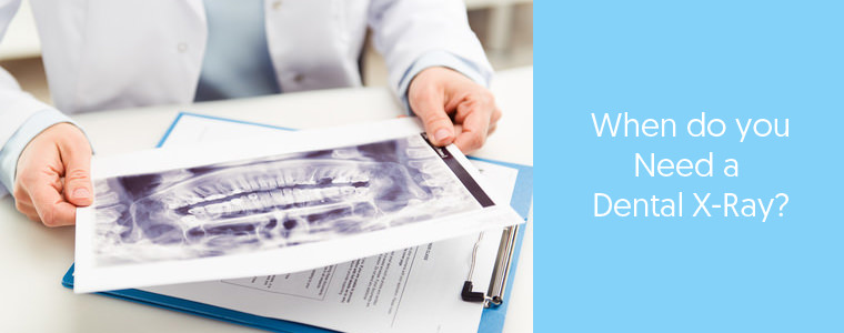 Is it necessary to take a Dental X-Ray?