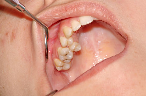 Upper jaw - Malocclusion molars