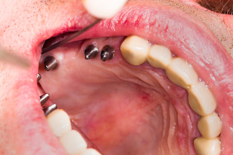 Major Dental - Implants and Bridge work