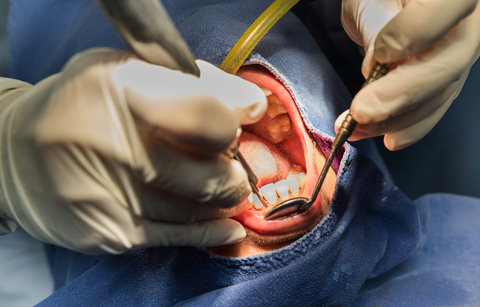 Major Dental - Root Canal Therapy