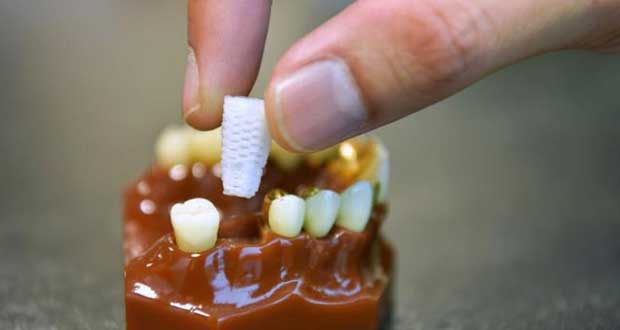 3d-Printed Dental Plugs