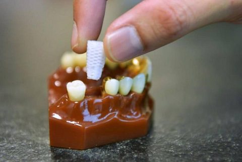 3D dental plugs feature image dental aware