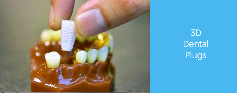 3D Dental Plugs