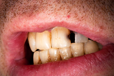 Tooth decay can cause sensitivity in your teeth