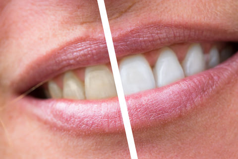 Professional Teeth Whitening