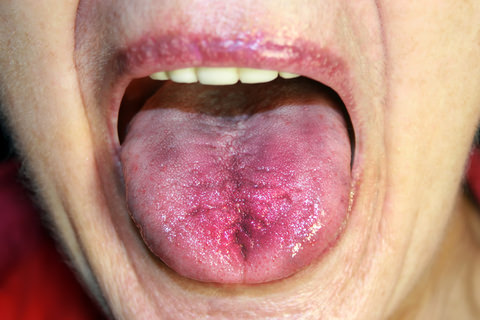 A lady with Burning Mouth Syndrome