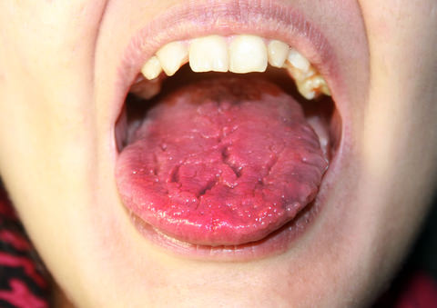 Burning Mouth Syndrome