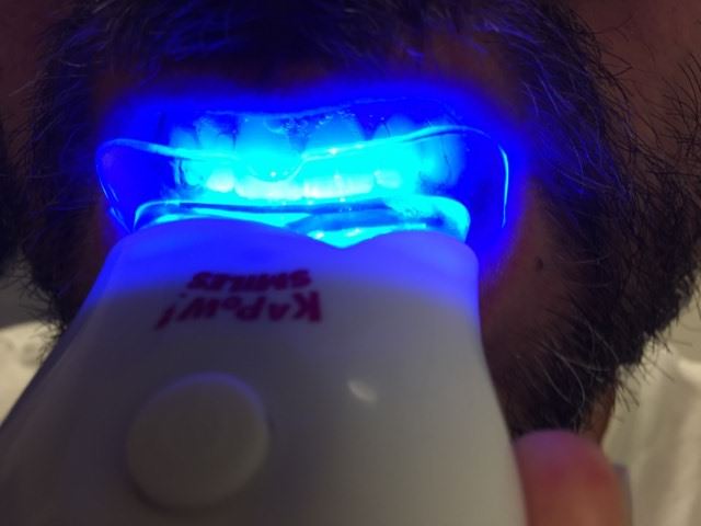 Using the Kapow Smiles teeth whitening LED light