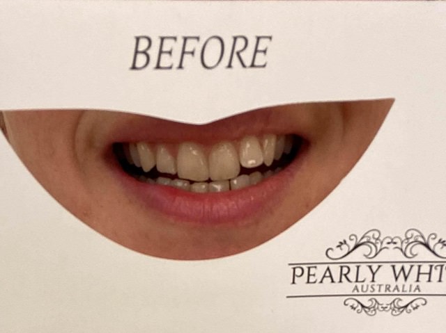 Before using the Pearly Whites Starter kit