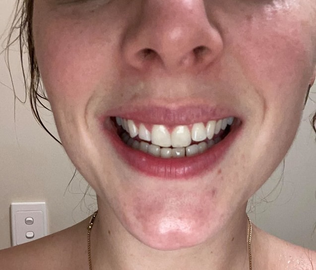 After photo using the the Pearly Whites Starter kit