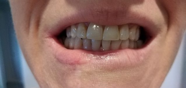 Before photo of Smile Bright White