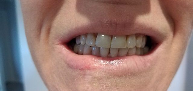 After photo of Smile Bright White