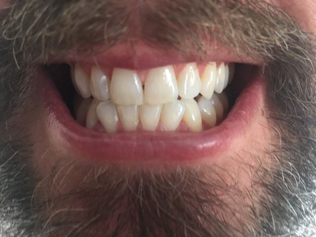 4 weeks in using the Colgate Optic White Stain-Less White Toothpaste