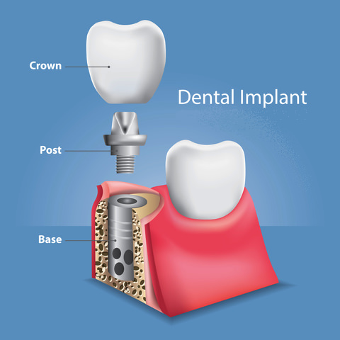 There are 3 parts to a dental implant