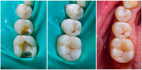 Dental filling stages