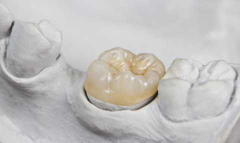 A dental onlay