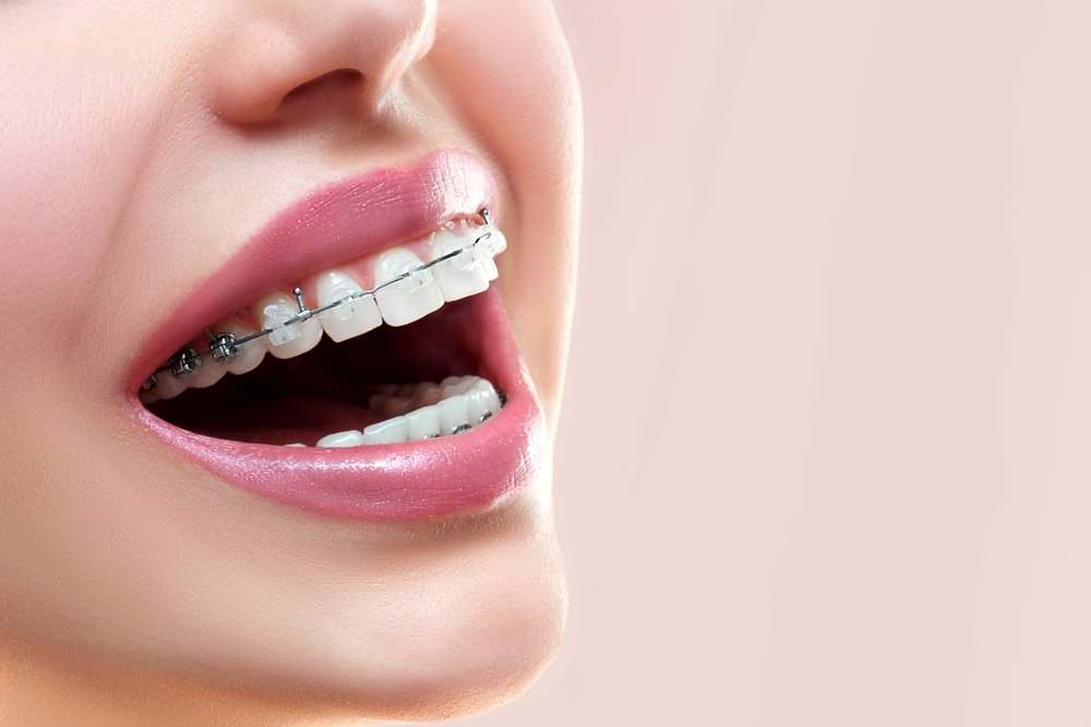 Ceramic braces