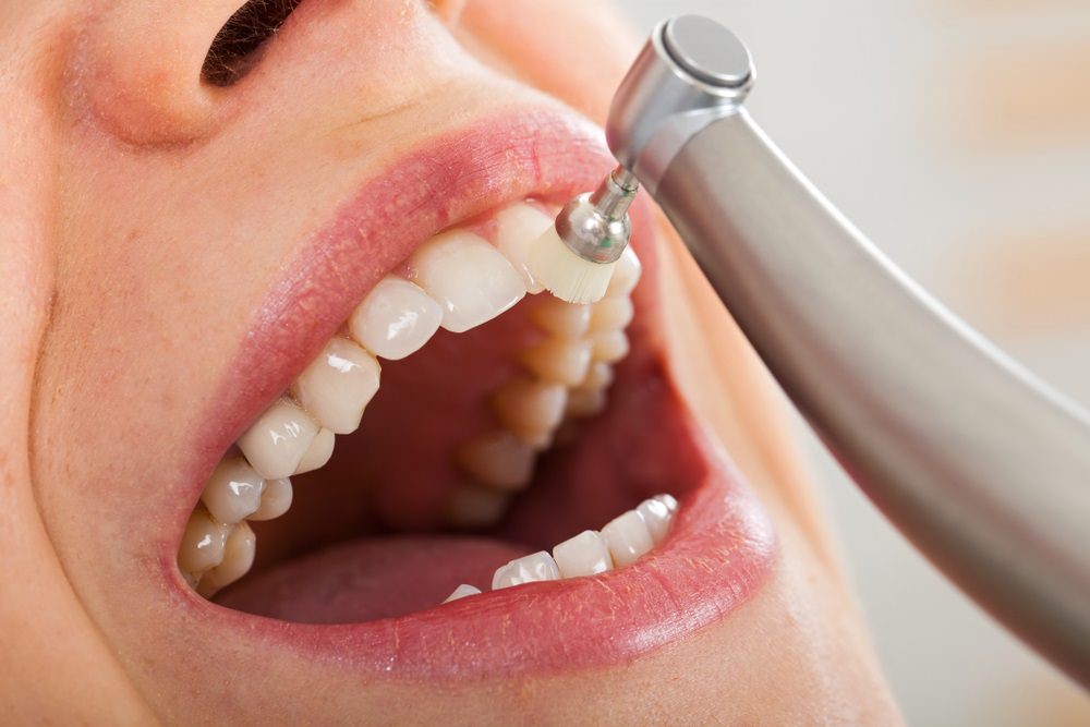 Dental Cost for Teeth Cleaning – All Your Options Listed Dental Aware