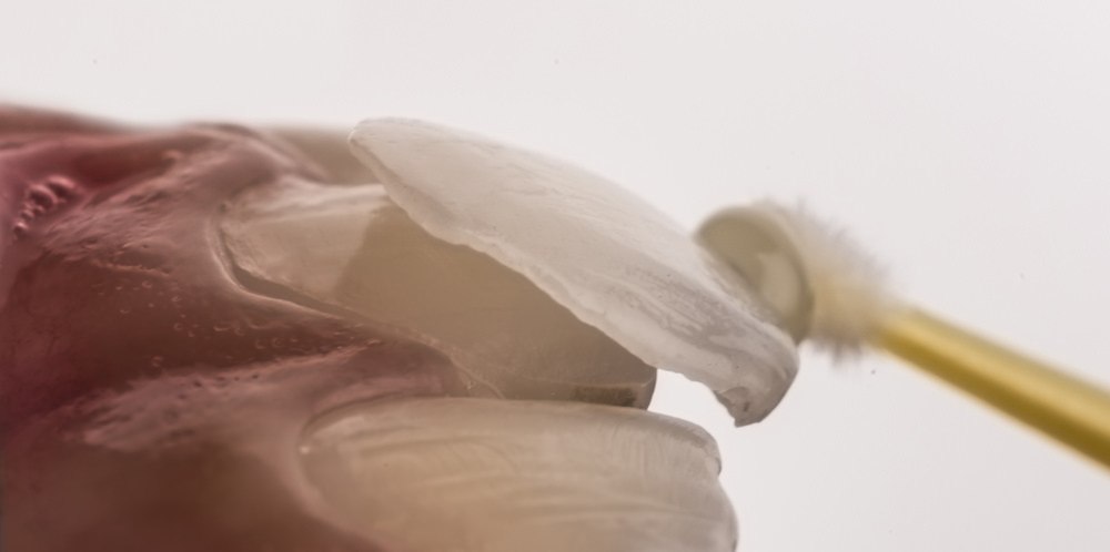 A dental veneer being placed on a tooth