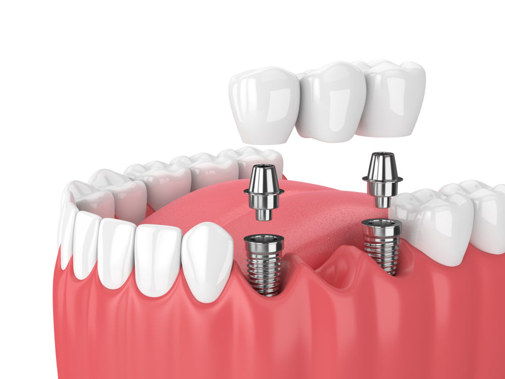 3D image of a dental implant