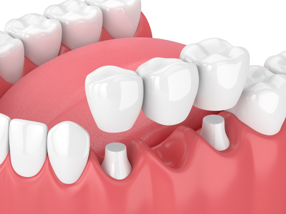 3D illustration of a 3 unit dental bridge