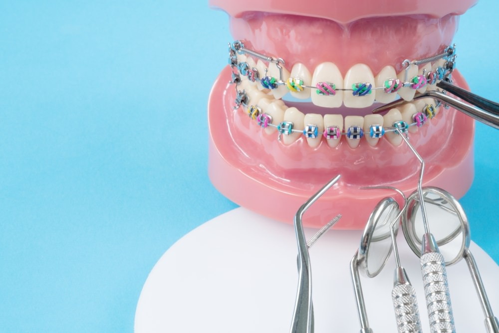 traditional braces on a teeth model