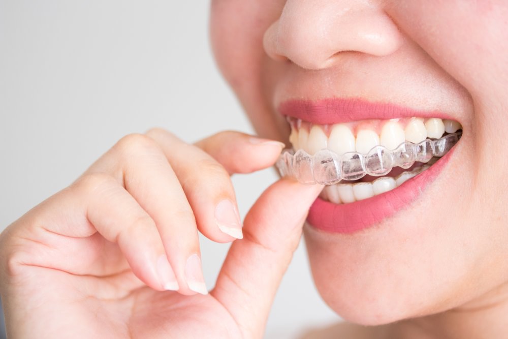 A woman wearing a clear dental aligner