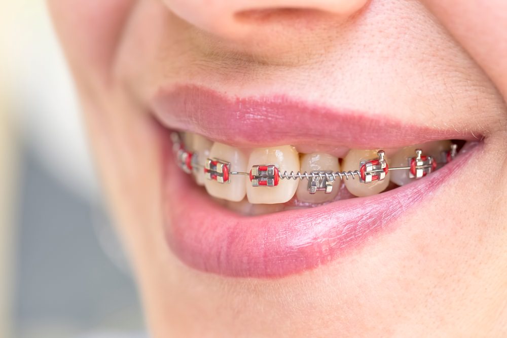 A lady wearing dental braces