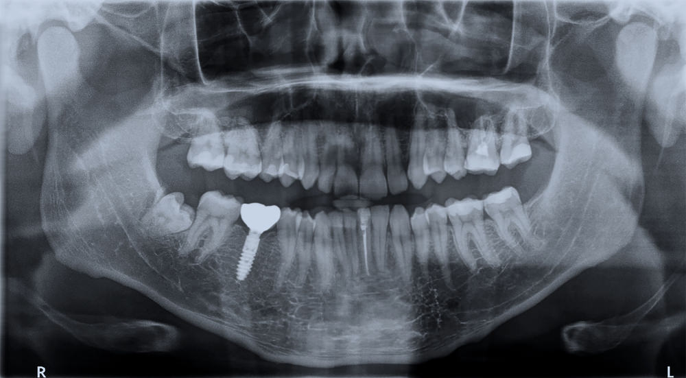 A dental xray showing a dental implant
