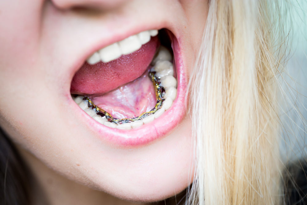 Lingual braces