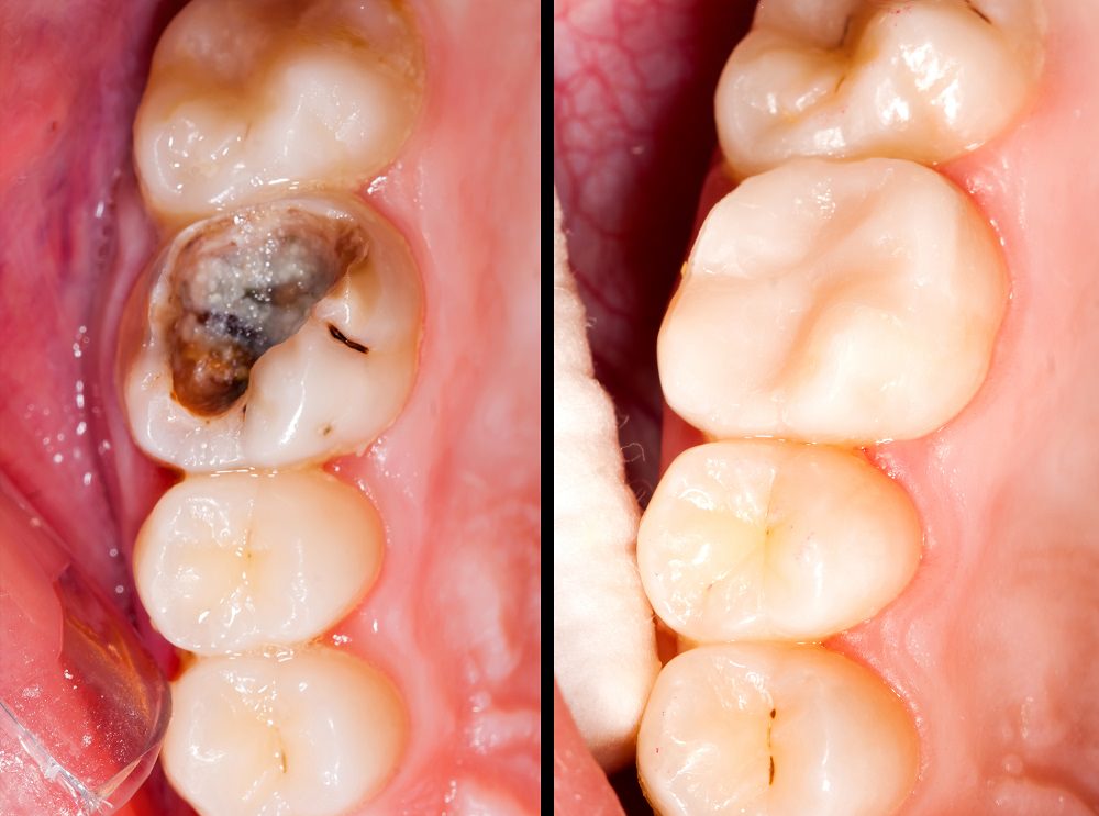 Porcelain dental filling