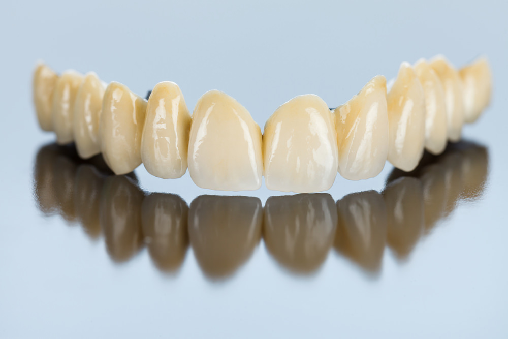 Dental cost bridge feature image