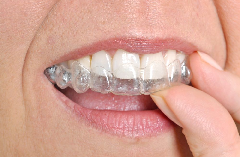 A person wearing clear dental aligners