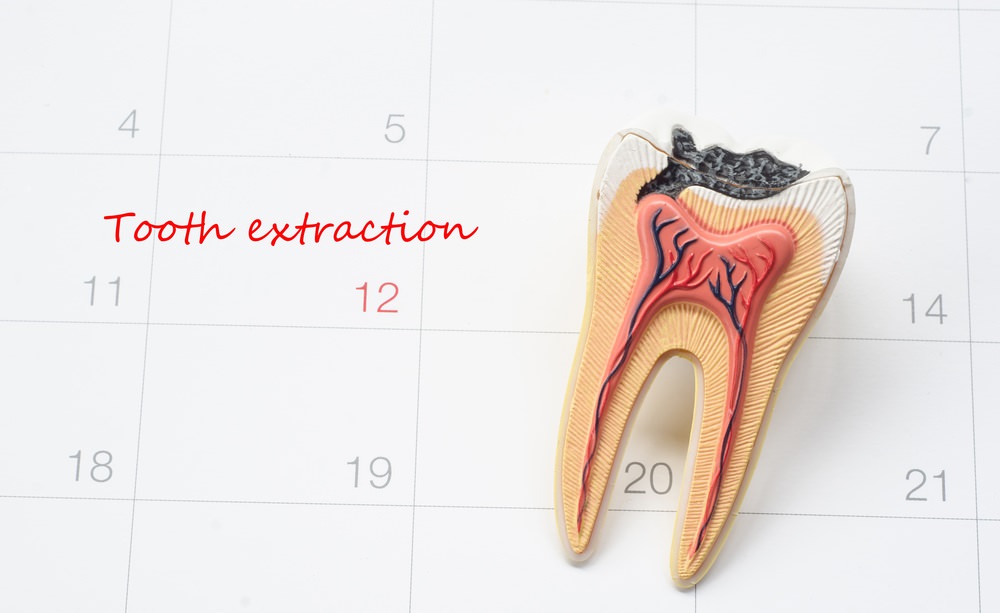 Tooth extraction text with a tooth and calendar